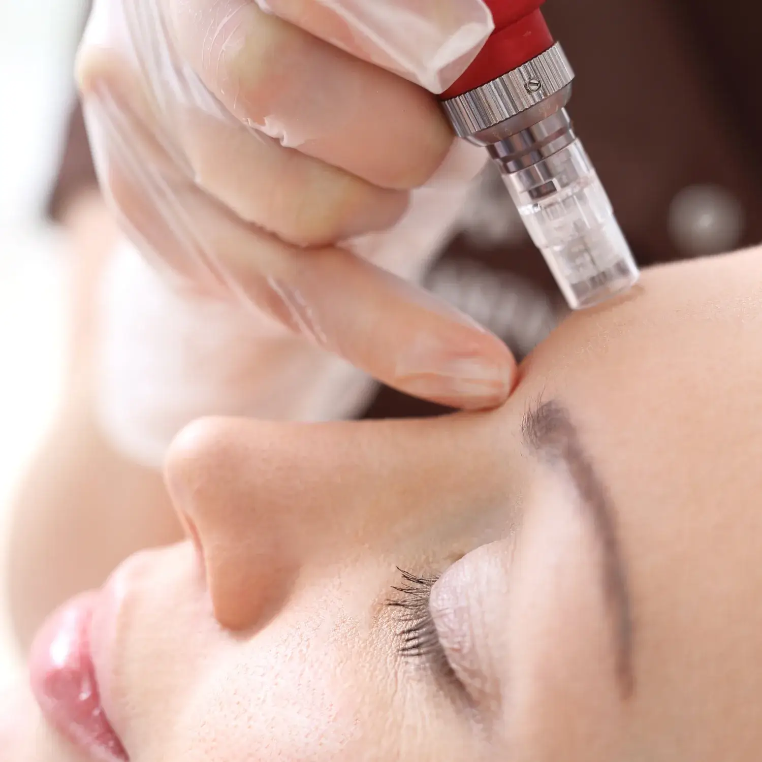 MICRONEEDLING